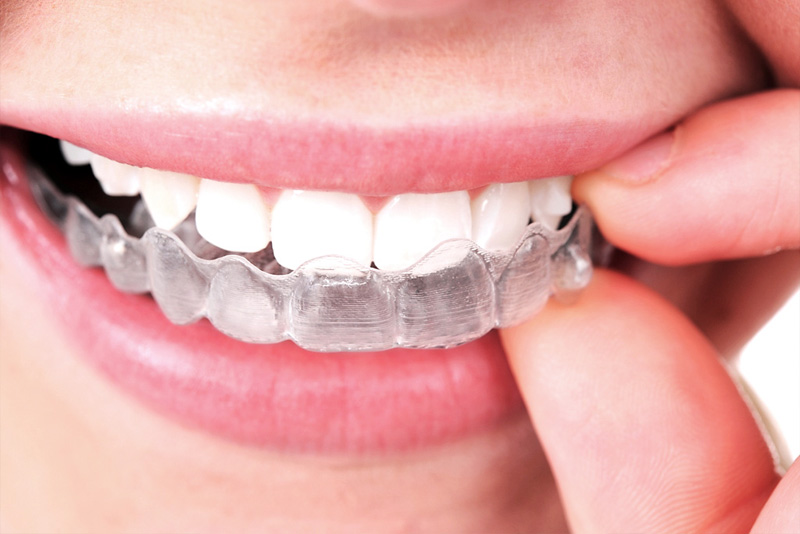 Clear aligner example